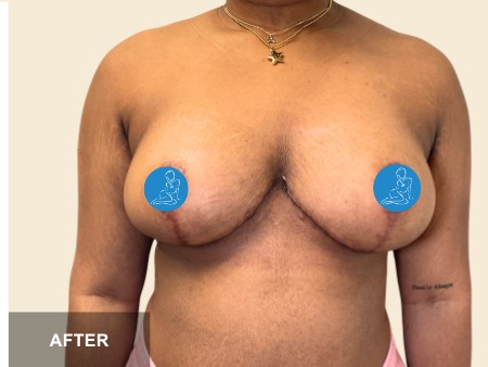Breast Reduction before and after - after
