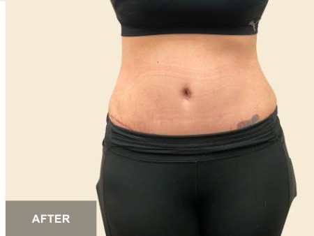 Tummy Tuck before and after - after