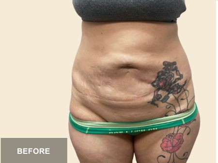 Tummy Tuck before and after - before