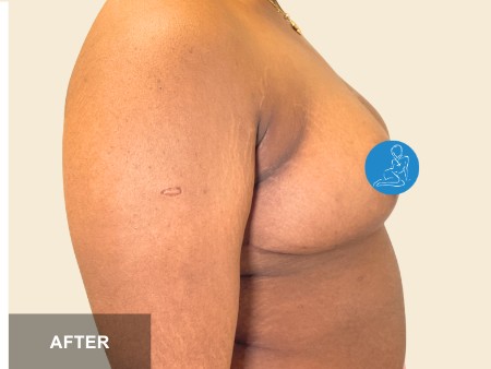 Breast Reduction before and after - after