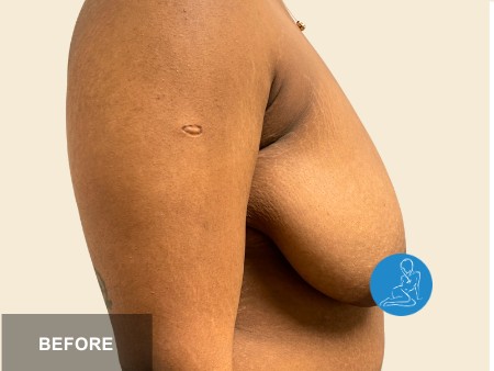 Breast Reduction before and after - before