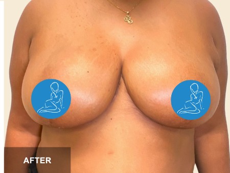 Breast Reduction before and after - after