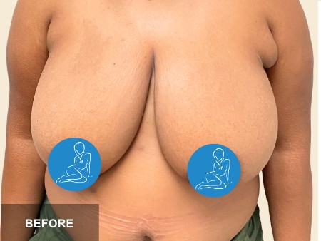 Breast Reduction before and after - before