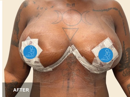 Breast Reduction before and after - after