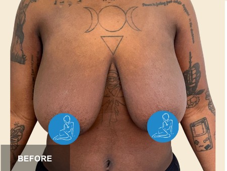 Breast Reduction before and after - before