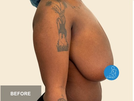 Breast Reduction before and after - before