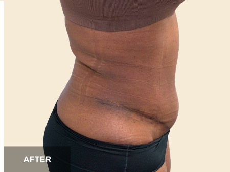 Tummy Tuck before and after - after
