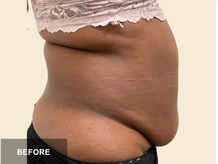 Tummy Tuck before and after - before