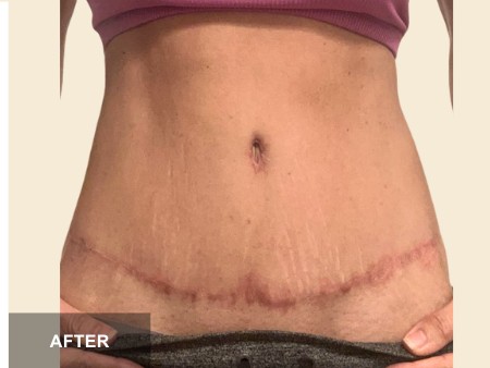 Tummy Tuck before and after - after