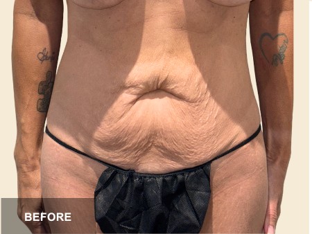 Tummy Tuck before and after - before