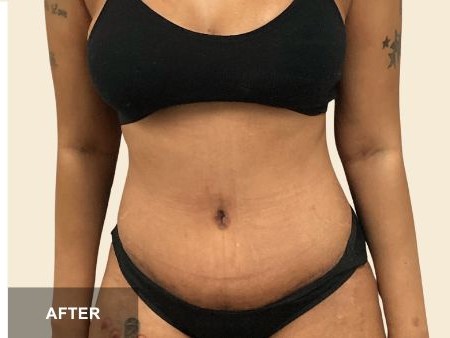 Tummy Tuck before and after - after