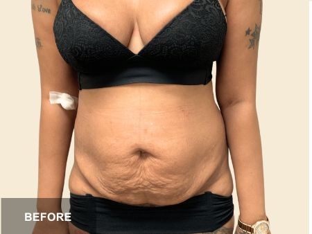Tummy Tuck before and after - before