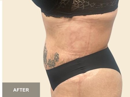 Tummy Tuck before and after - after