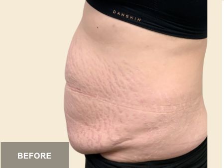 Tummy Tuck before and after - before