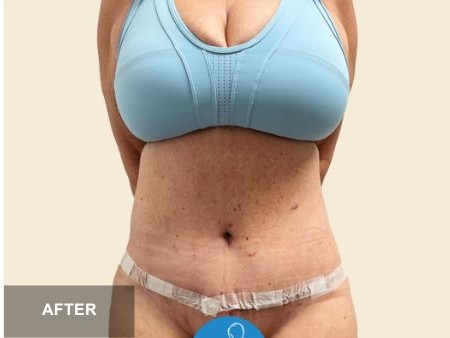 Tummy Tuck before and after - after