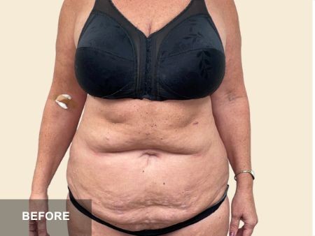 Tummy Tuck before and after - before
