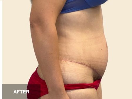 Tummy Tuck before and after - after