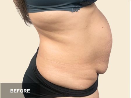 Tummy Tuck before and after - before