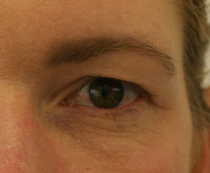 Brow Lift before and after - after