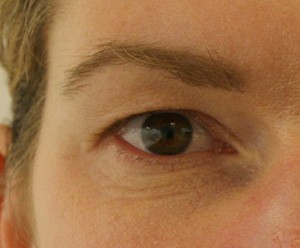 Brow Lift before and after - before