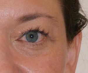 Brow Lift before and after - after