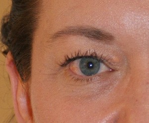 Brow Lift before and after - before