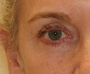 Brow Lift before and after - before