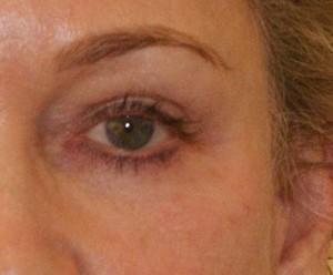Brow Lift before and after - after