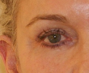 Brow Lift before and after - before