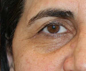 Brow Lift before and after - before