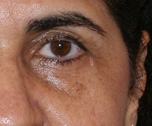Brow Lift before and after - after