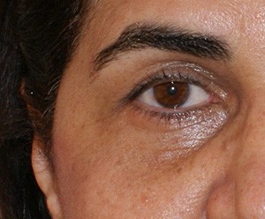 Brow Lift before and after - before