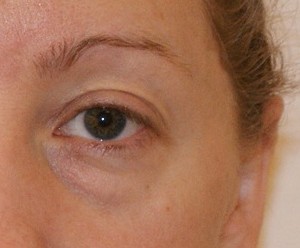 Brow Lift before and after - after