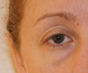 Brow Lift before and after - before