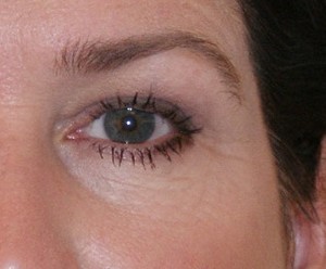 Brow Lift before and after - after