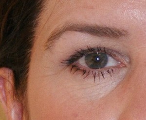 Brow Lift before and after - before