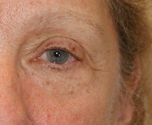 Brow Lift before and after - after