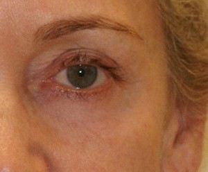 Brow Lift before and after - after