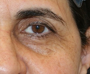 Brow Lift before and after - after