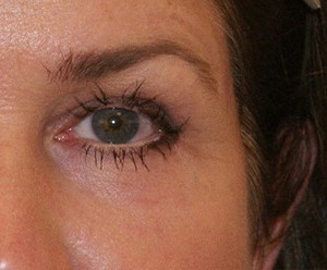 Brow Lift before and after - after