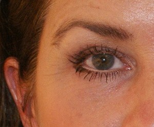 Brow Lift before and after - before