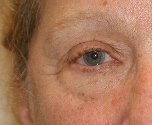 Brow Lift before and after - before