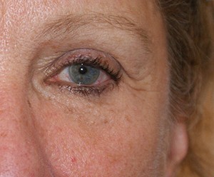 Brow Lift before and after - after