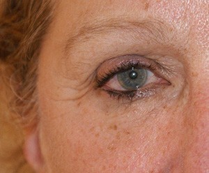 Brow Lift before and after - before