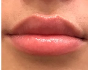 Lip Augmentation after — Dr. Anna Avaliani