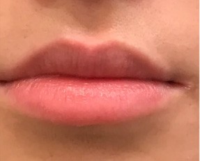 Lip Augmentation before — Dr. Anna Avaliani