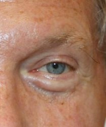 Lower Blepharoplasty before and after - after