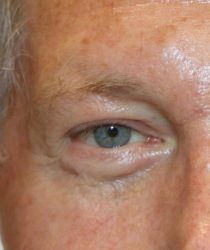 Lower Blepharoplasty before and after - before