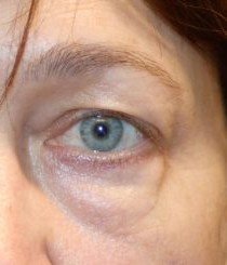 Lower Blepharoplasty before and after - after