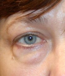 Lower Blepharoplasty before and after - before